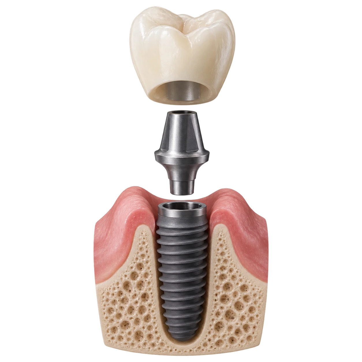 Разобранная учебная конструкция имплант–соединительный элемент–коронка